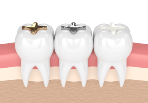 Cross-section of three molar teeth with gold, silver amalgam, and white composite fillings, embedded in gum and jawbone.