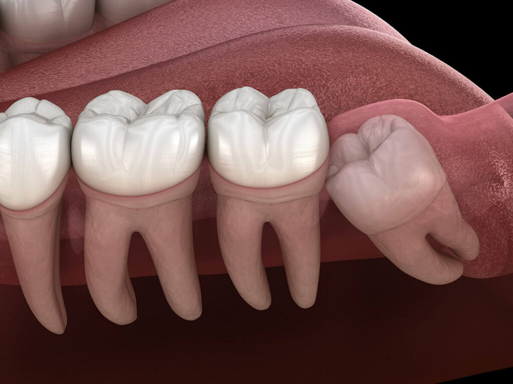 Graphic showing an impacted wisdom tooth.