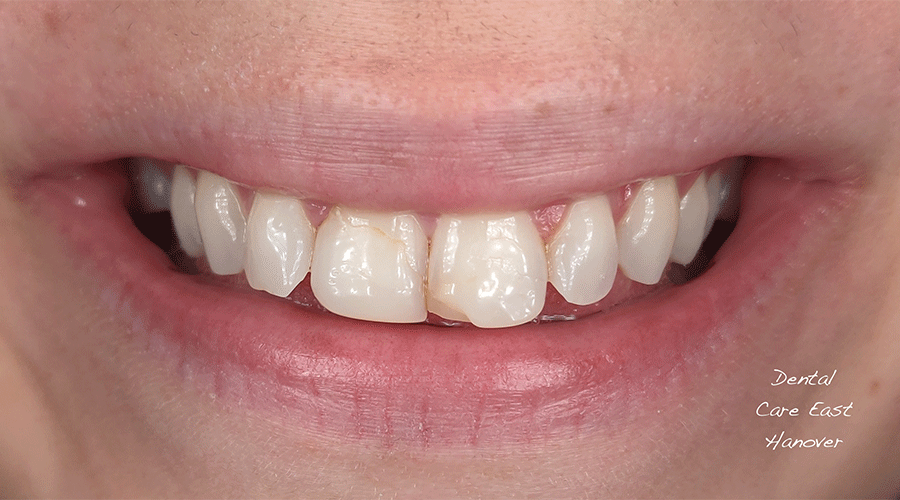 Photo of a patient's smile before cosmetic treatment at Dental Care East Hanover.
