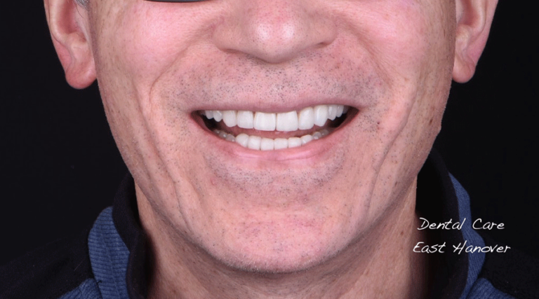 Photo of a patient's smile after cosmetic treatment at Dental Care East Hanover.