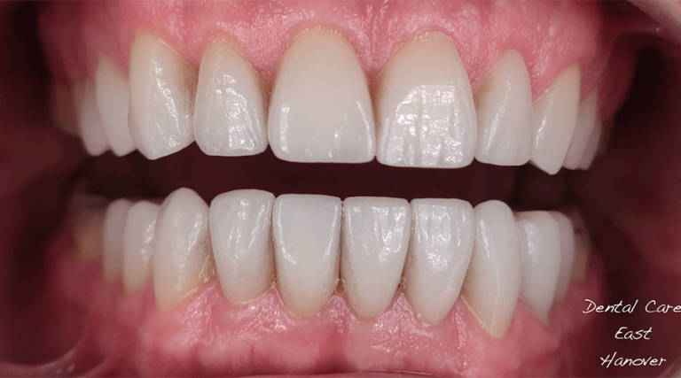 Photo of a patient's smile after cosmetic treatment at Dental Care East Hanover.
