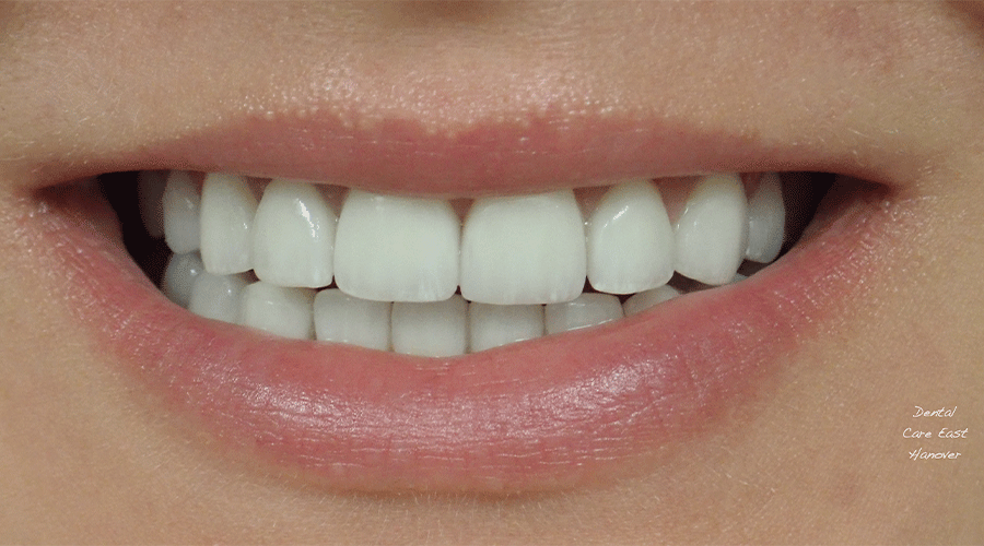 Photo of a patient's smile after cosmetic treatment at Dental Care East Hanover.