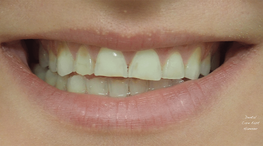 Photo of a patient's smile before cosmetic treatment at Dental Care East Hanover.