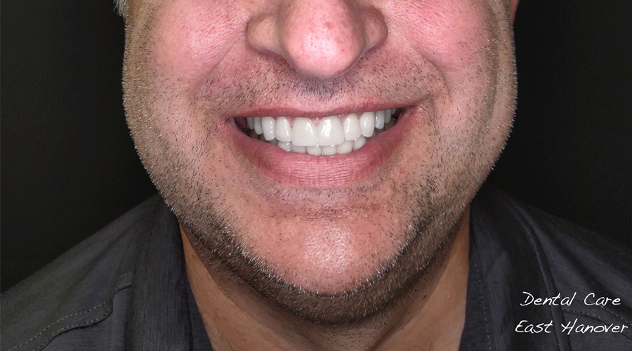 Photo of a patient's smile after cosmetic treatment at Dental Care East Hanover.