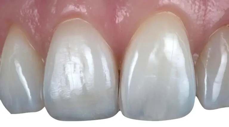 After Dental Care East Hanover's Dental Restoration Work