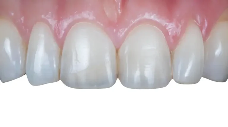 After Dental Care East Hanover's Dental Restoration Work