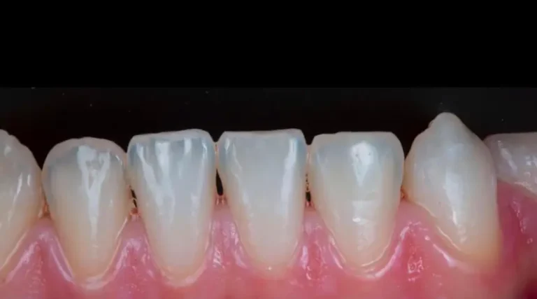 After Dental Care East Hanover's Dental Restoration Work