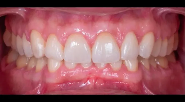 After Dental Care East Hanover's Dental Restoration Work