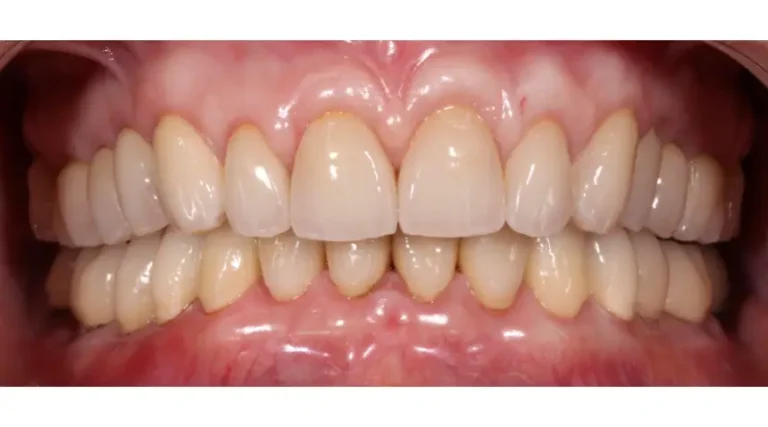 After Dental Care East Hanover's Dental Restoration Work