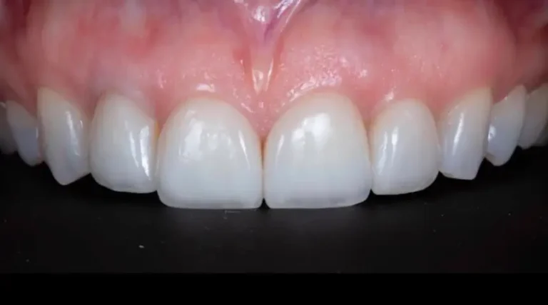 After Dental Care East Hanover's Dental Restoration Work