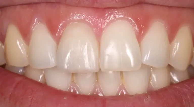 After Dental Care East Hanover's Dental Restoration Work