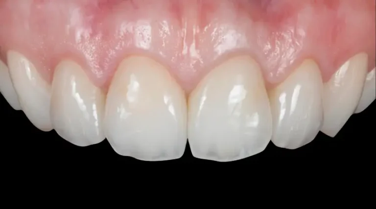 After Dental Care East Hanover's Dental Restoration Work