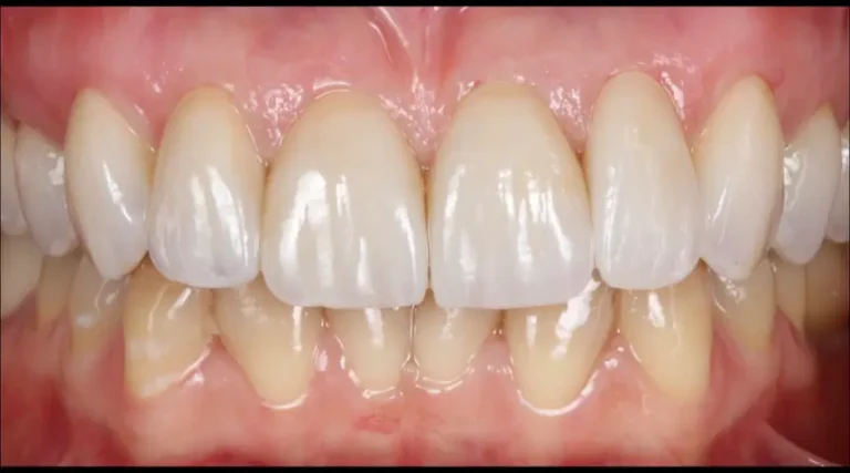 After Dental Care East Hanover's Dental Restoration Work