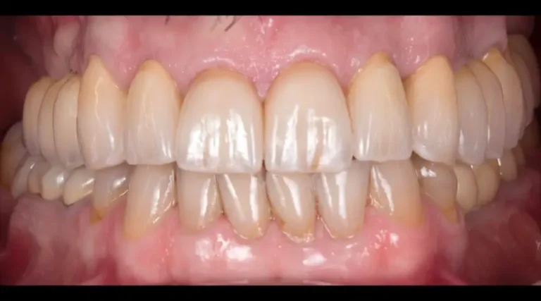 After Dental Care East Hanover's Dental Restoration Work