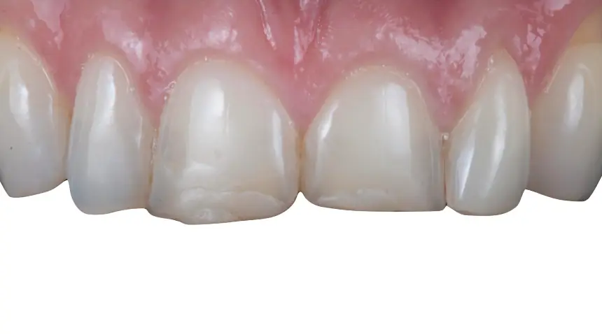 Before Dental Care East Hanover's Dental Restoration Work