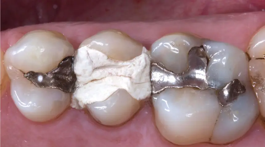 Before Dental Care East Hanover's Dental Restoration Work