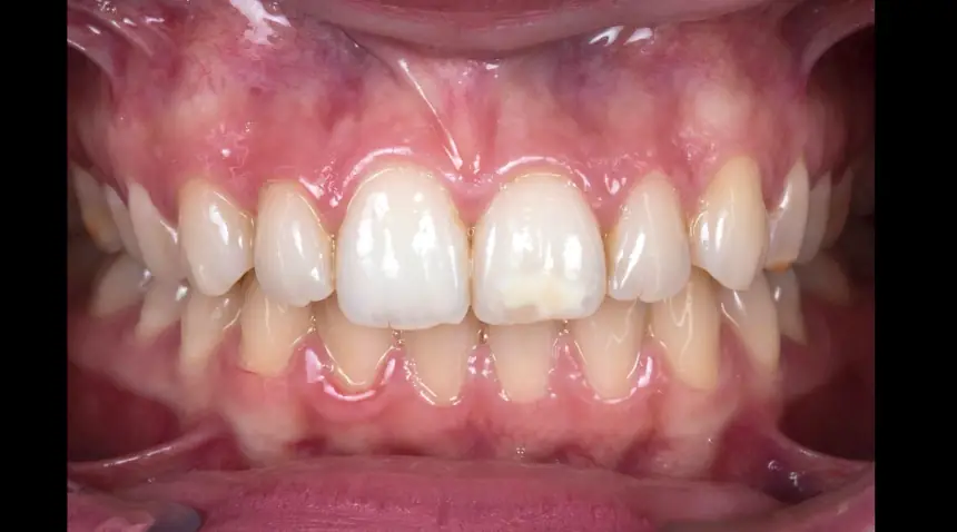 Before Dental Care East Hanover's Dental Restoration Work