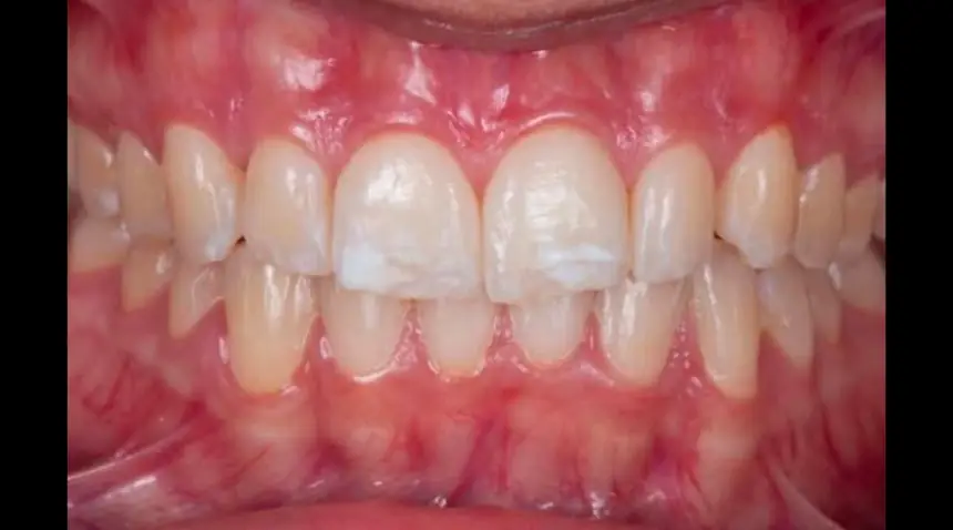 Before Dental Care East Hanover's Dental Restoration Work