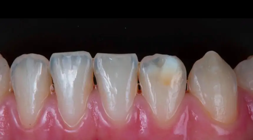 Before Dental Care East Hanover's Dental Restoration Work