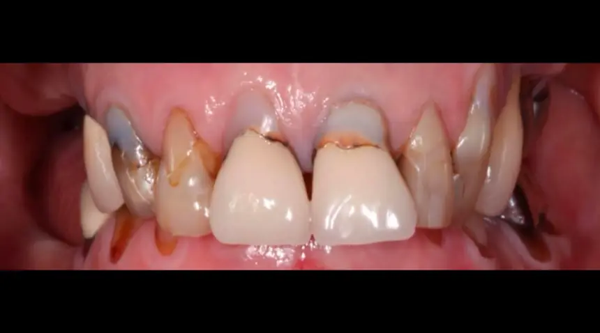 Before Dental Care East Hanover's Dental Restoration Work