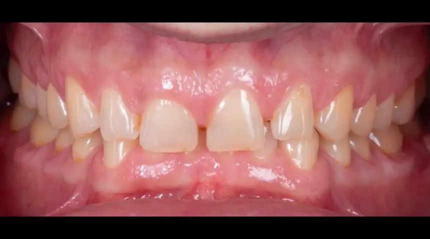 Before Dental Care East Hanover's Dental Restoration Work