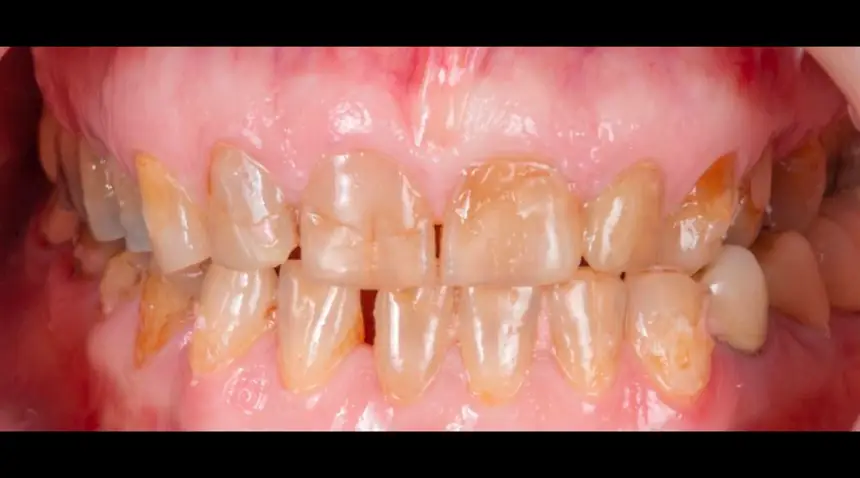 Before Dental Care East Hanover's Dental Restoration Work