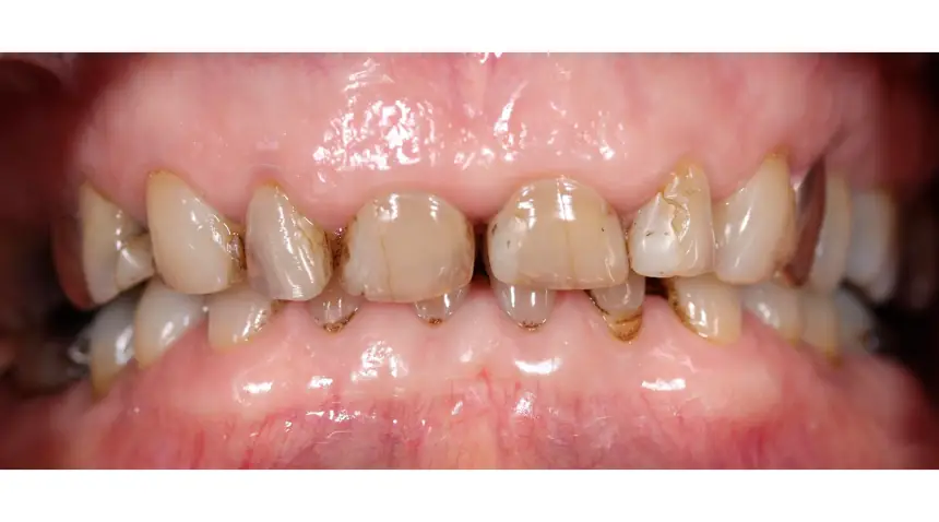 Before Dental Care East Hanover's Dental Restoration Work