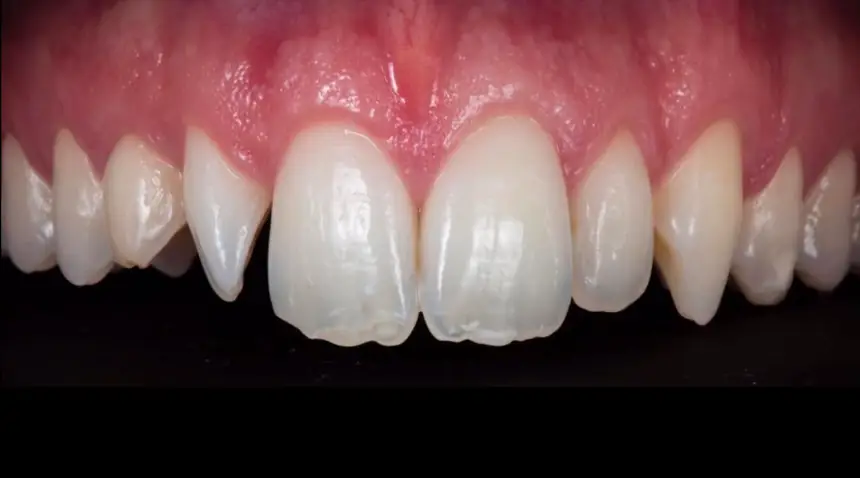 Before Dental Care East Hanover's Dental Restoration Work