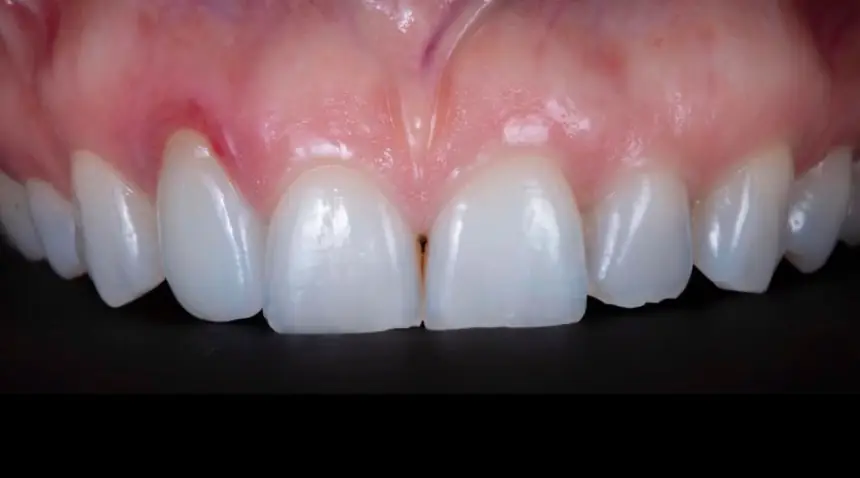 Before Dental Care East Hanover's Dental Restoration Work