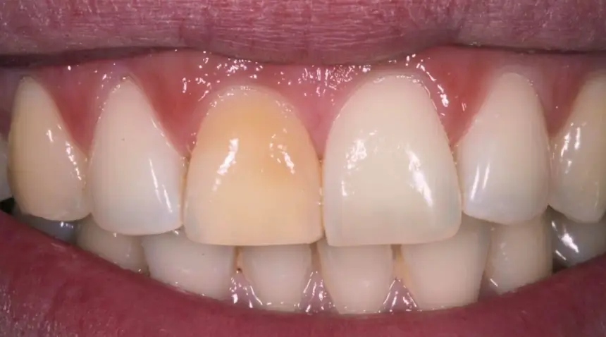 Before Dental Care East Hanover's Dental Restoration Work