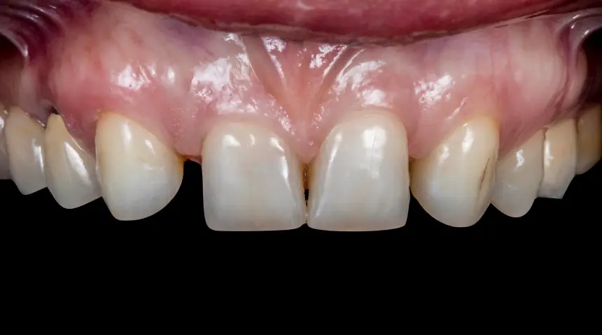 Before Dental Care East Hanover's Dental Restoration Work