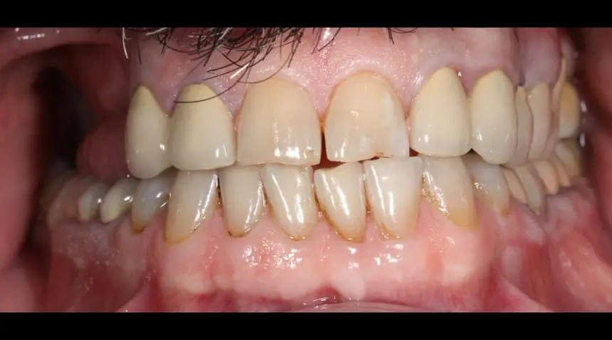 Before Dental Care East Hanover's Dental Restoration Work