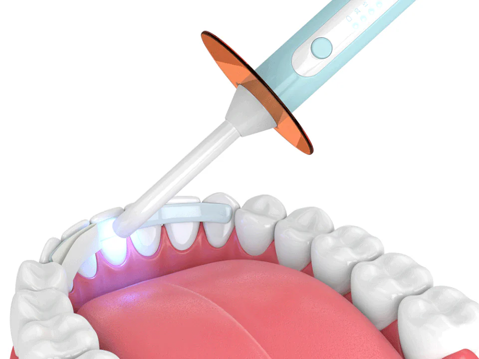 Dental bonding available at Dental Care East Hanover in Hanover, NJ