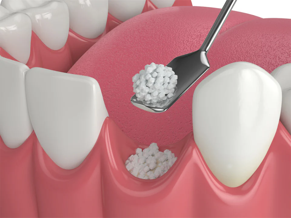 Dental bone grafting available at Dental Care East Hanover in East Hanover, NJ