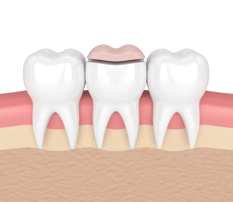 Dental inlays and onlays available at Dental Care East Hanover in East Hanover, NJ