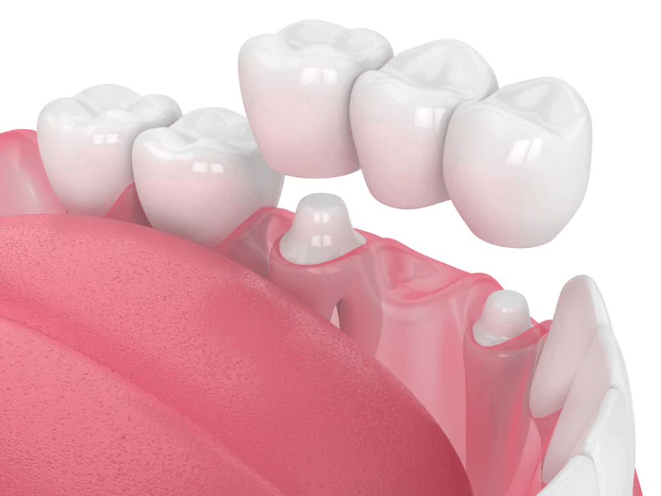 Same-day dental crowns and bridges available at Dental Care East Hanover in Hanover, NJ
