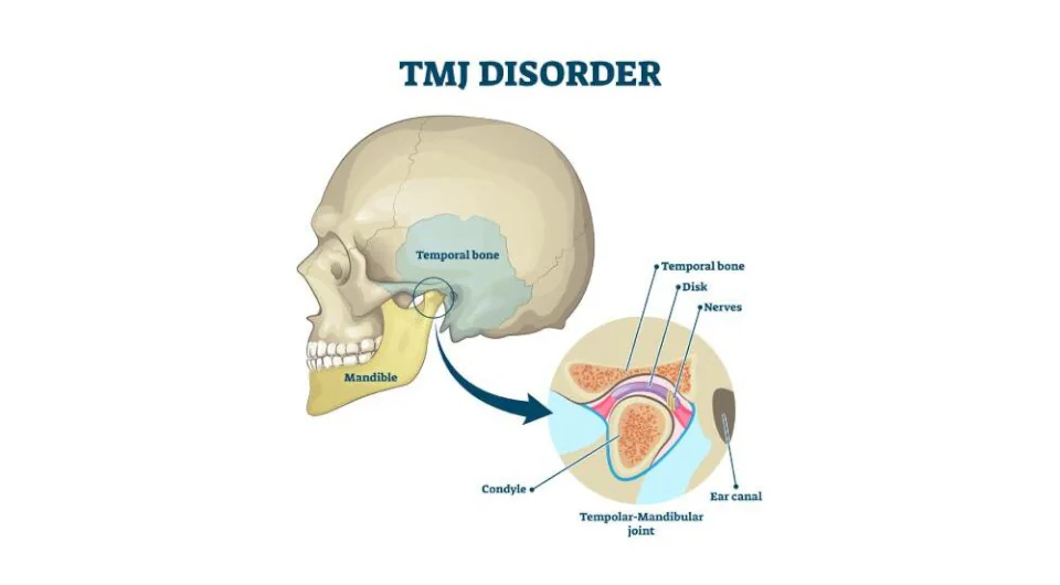 TMJ disorder treatments available at Dental Care East Hanover in East Hanover, NJ