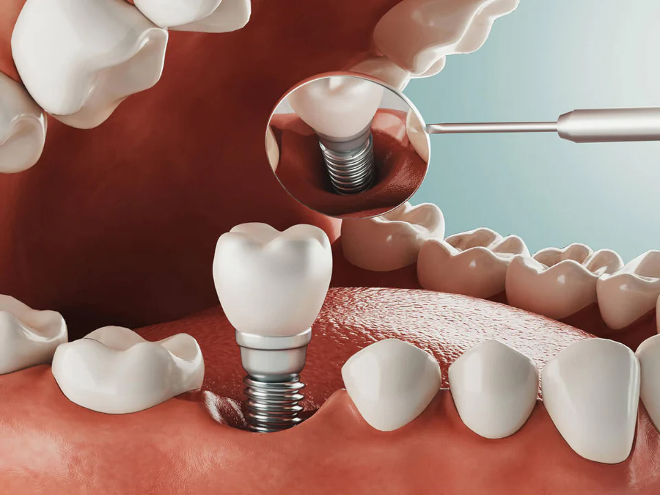 Dental implant services available at Dental Care East Hanover in Hanover, NJ