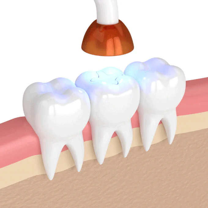 Dental fillings available at Dental Care East Hanover in East Hanover, NJ