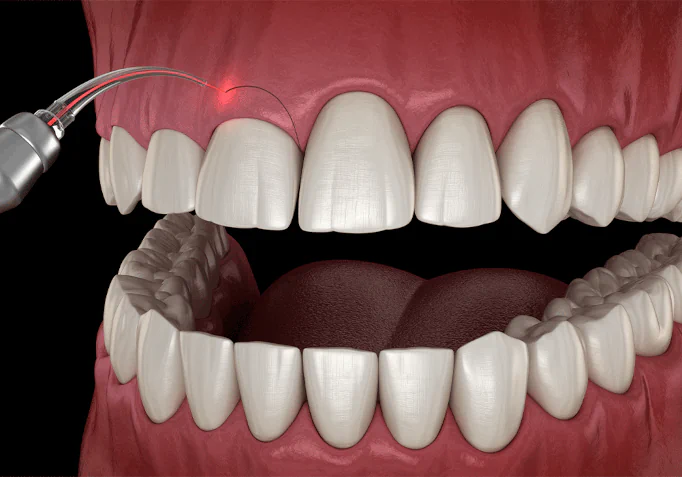 Gummy smile treatment at Dental Care East Hanover in East Hanover, NJ
