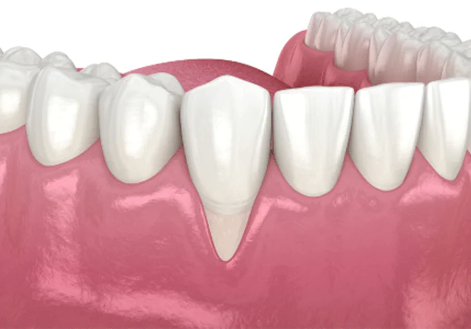 Receding gumline treatments at Dental Care East Hanover in East Hanover, NJ